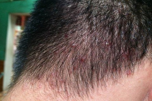 Ngứa da đầu và nổi mụn là dấu hiệu của bệnh gì?