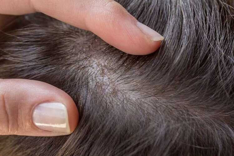 Tóc rụng có hạt trắng như nhân mụn ở chân có nguy hiểm không?